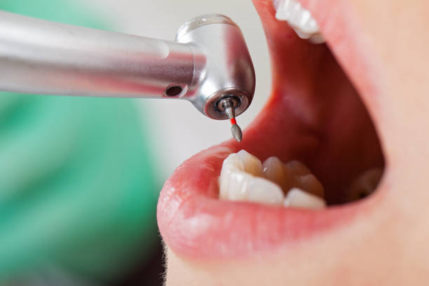 Best Emergency Dental Care for Broken or Chipped Teeth in Sanborn, NY